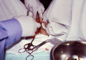 Himenoplastia, 2004